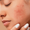 acne scars