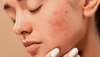 acne scars